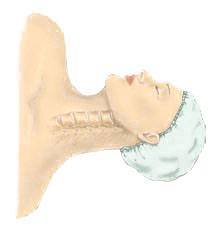 Anterior Cervical Discectomy w/ Fusion